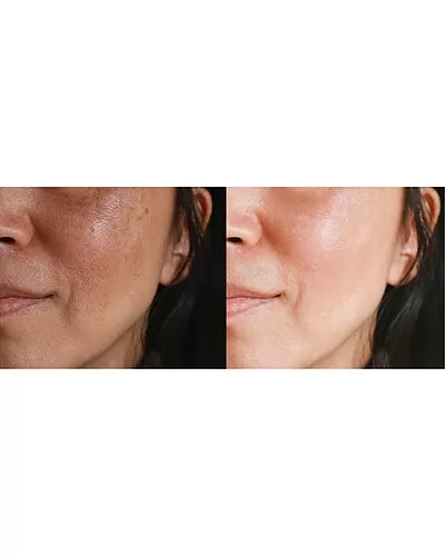 Skin Rejuvenation Device Women 2 Skin Rejuvenation Device Women - Image 2